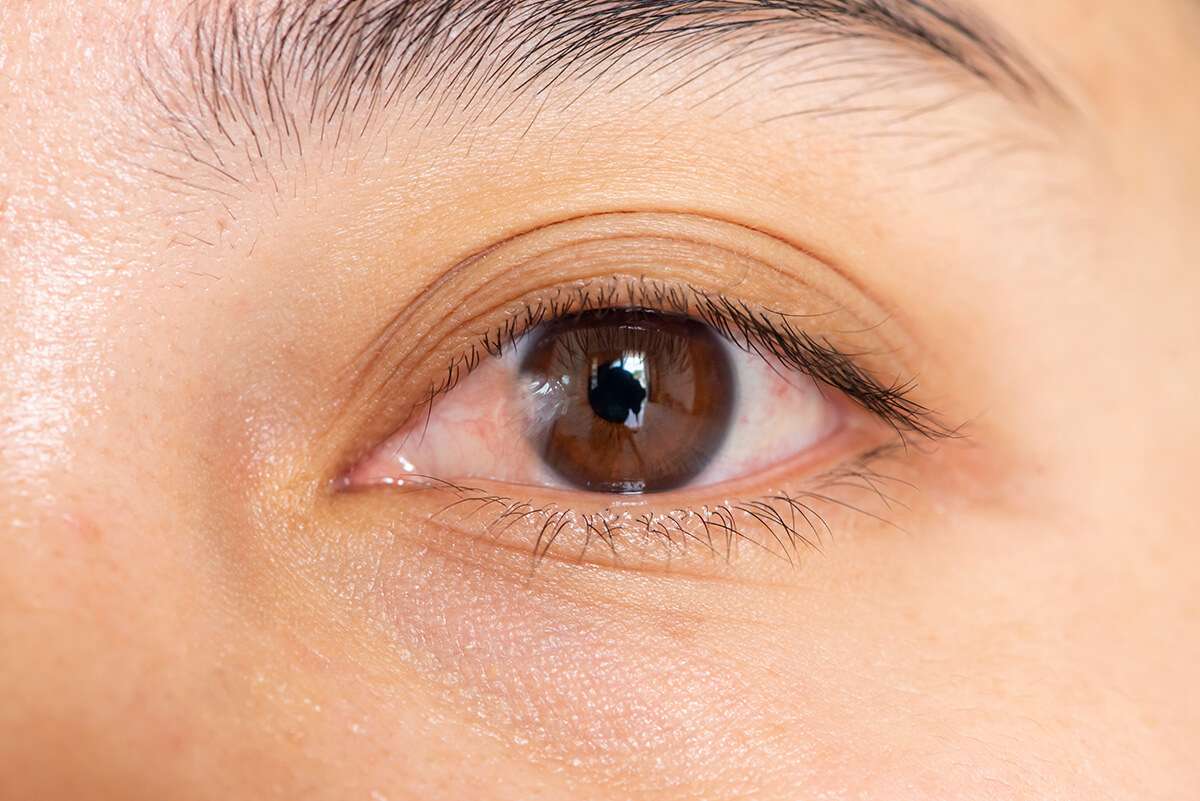Do I Need My Pterygium Removed?