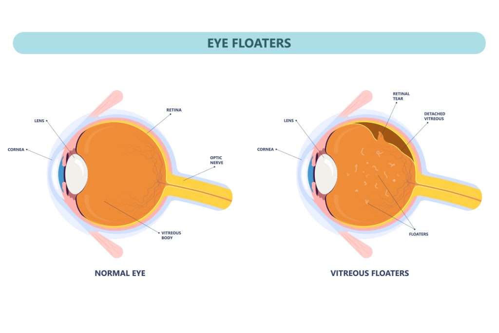 Eye Floaters